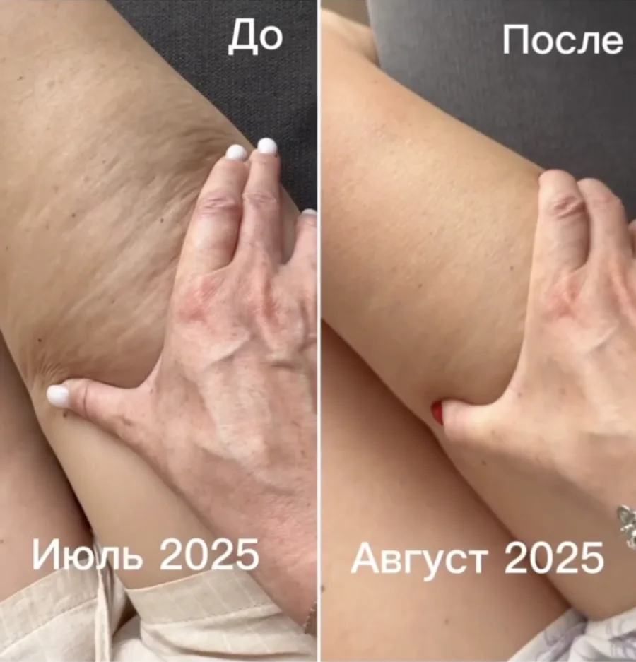 Кожа бедра: июль и август 2025